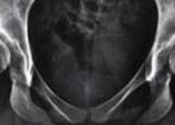 Acetabular Dysplasia