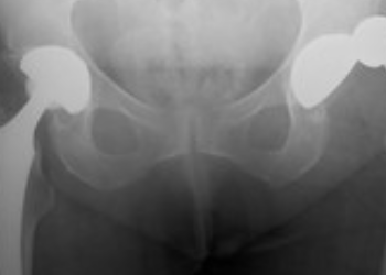 Revision Total Hip replacement