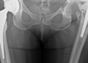 Hip Replacement – Infection