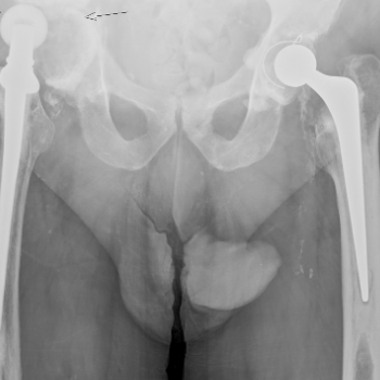 Hip Replacement – Disolocated Hip