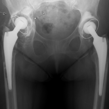 Hip Replacement – Bone Loss