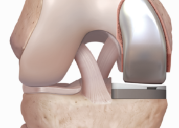 Unicompartmental knee replacement
