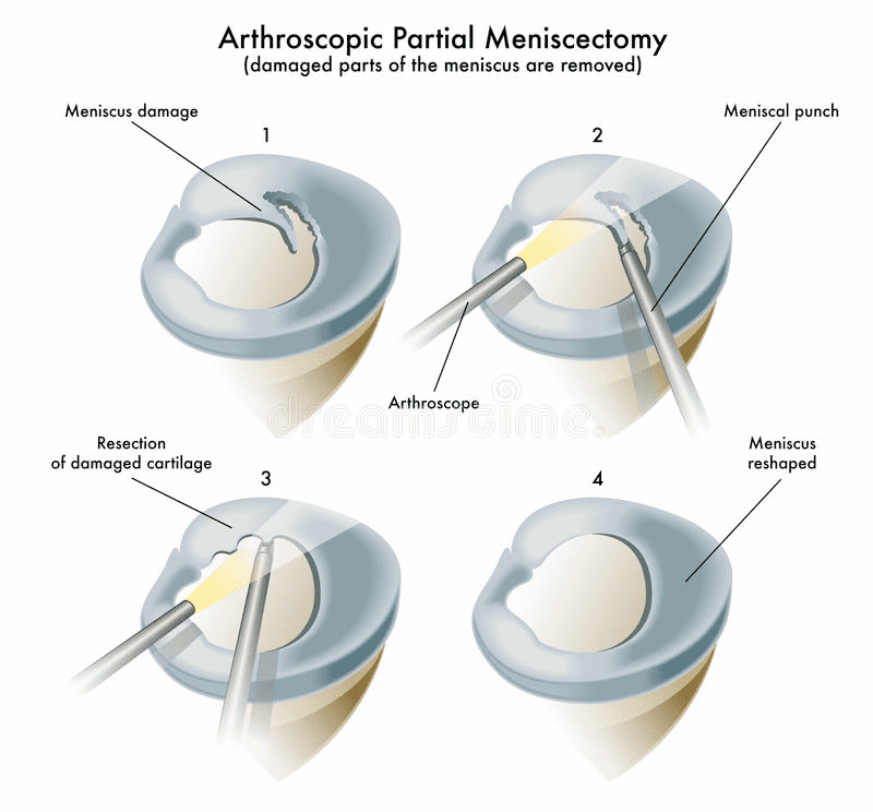 knee-arthroscopy-gorav-datta