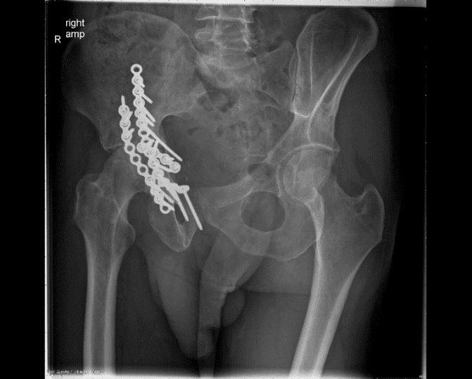 acetabular fracture