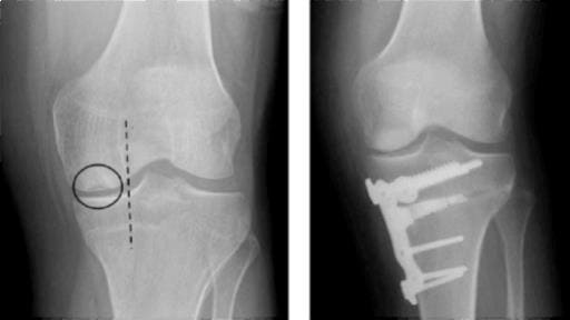 Pre and post op medial osteoarthritis 