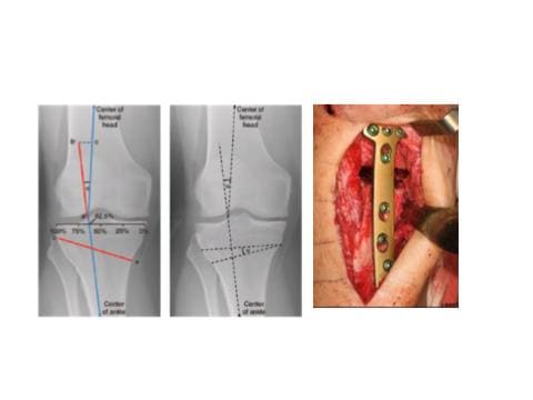 High Tibial Osteotomy | Gorav Datta